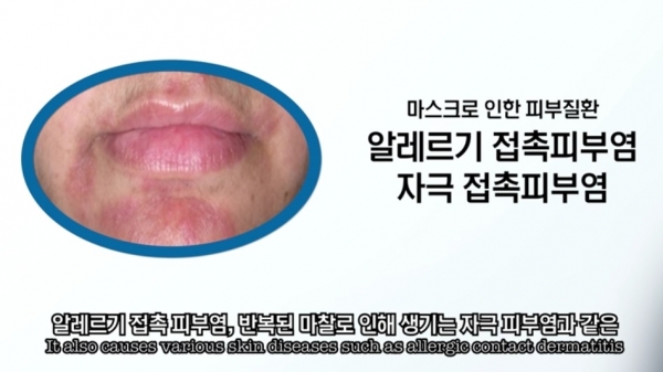 마스크로 인한 알레르기 접촉피부염. 사진=김홍석 원장/굿모닝충청 김수미 기자