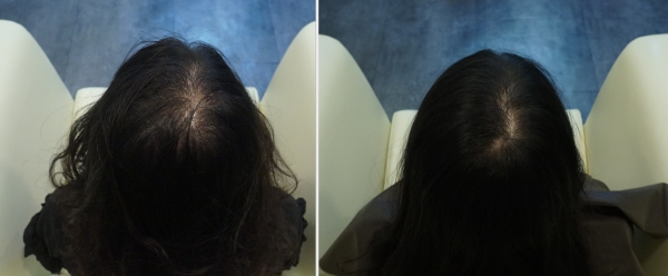 6개월 동안 주사 치료를 받은 20대 여성 전(사진 좌)과 후 비교. 사진=청주 미앤모/굿모닝충청 김수미 기자