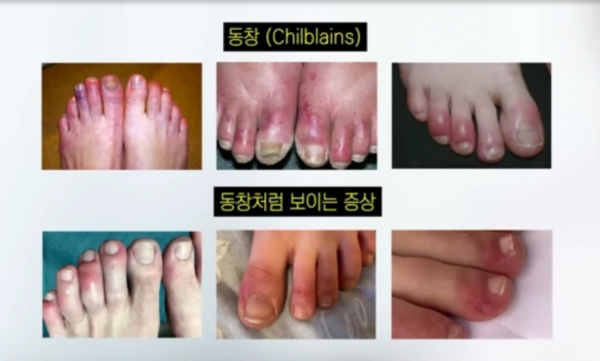 코로나19 감염이 의심되는 피부증상으로 '동창'과 '동창처럼 보이는 피부증상'을 비교했다. 사진=김홍석 원장/굿모닝충청 김수미 기자