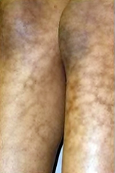 열성홍반의 증상. 사진=김홍석 원장/굿모닝충청 김수미 기자