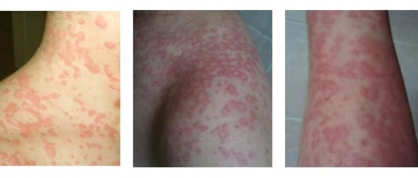 옻 알레르기로 인한 피부 증상. 사진=와인피부과/굿모닝충청 김수미 기자