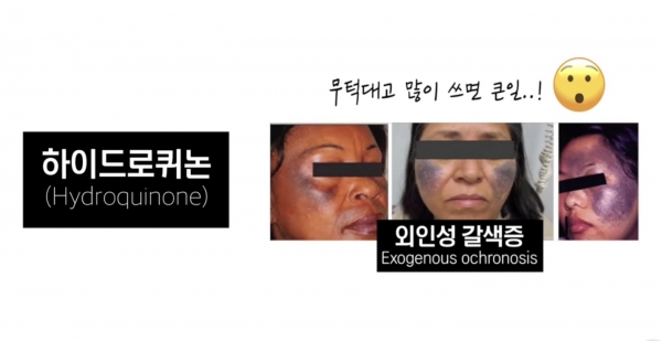 외인성갈색증 유발 사례. 사진=피알남/굿모닝충청 김수미 기자