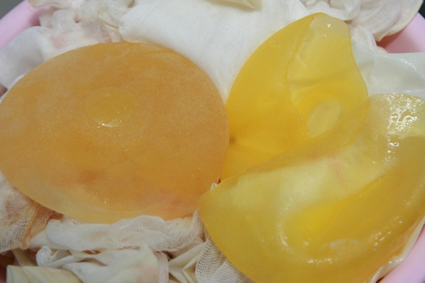 왼쪽 정상, 오른쪽 파열된 보형물. 사진=김영문 원장/ 굿모닝충청 김수미 기자