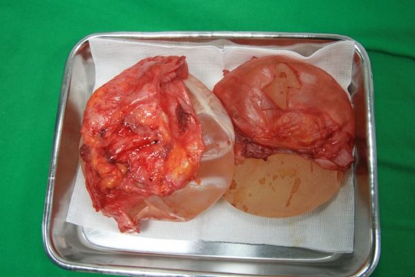 가슴 보형물을 싸고 있는 피막 제거. 사진=김영문 원장/굿모닝충청 김수미 기자