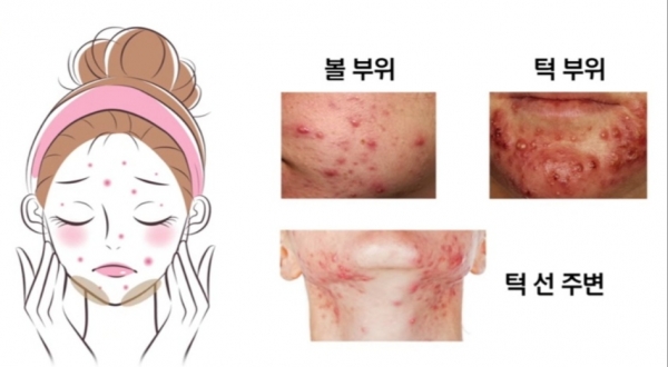 성인 여드름 발생 부위. 사진=김홍석 원/굿모닝충청 김수미 기자