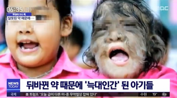 늑대인간 증후군. 사진=김인수 원장(MBC 뉴스 화면)/굿모닝충청 김수미 기자