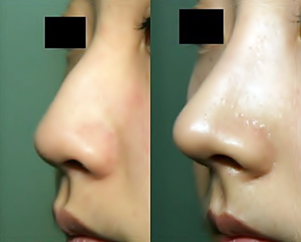 매부리코 교정 전후 모습. 사진=김영문 원장/굿모닝충청 김태린 기자