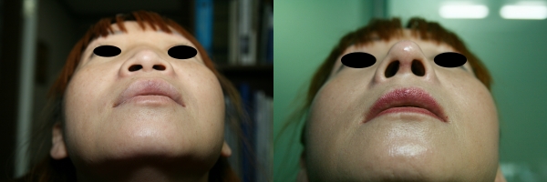 코수술 전후 비교. 사진=김영문 원장/굿모닝충청/김태린 기자