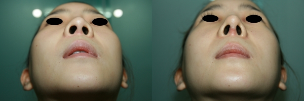 코수술 전후 비교. 사진=김영문 원장/굿모닝충청/김태린 기자