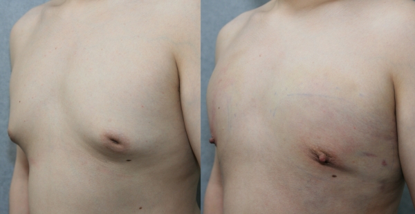 남성 함몰유두와 여성형유방 동시 교정 사례 측면. 사진=청주 미앤모 성형외과/굿모닝충청 김태린 기자