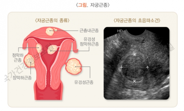 자궁근종. 사진=질병관리청 국가건강정보포털/굿모닝충청 박종혁 기자