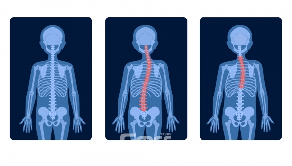 척추측만증은 척추가 휘어져 몸의 좌우 대칭이 불균형해지는 질환이다. 보통 10대 성장기 청소년들에게 많이 발생한다고 알려져 있으나, 잦은 스마트폰 사용 등 생활 습관으로 인해 자세가 올바르지 못한 청년층에게도 나타나고 있다. (사진=게티이미지뱅크/굿모닝충청 조연환 기자)