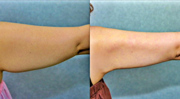 팔뚝 지방흡입 전후 비교 모습. (사진=청주 미앤모 성형외과 제공/굿모닝충청 김태린 기자)