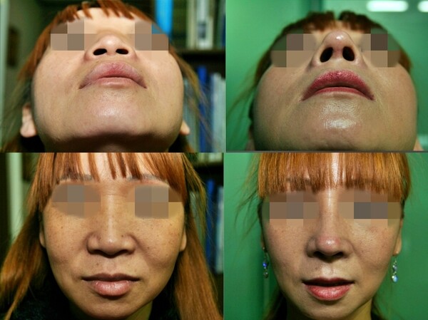 코 성형 전(왼쪽)후(오른쪽) 모습. (사진=청주 미앤모 성형외과 제공/굿모닝충청 김태린 기자)