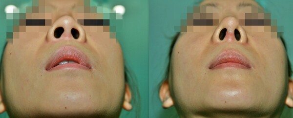 코 성형 재수술 전(왼쪽)후(오른쪽) 모습. (사진=청주 미앤모 성형외과 제공/굿모닝충청 김태린 기자)